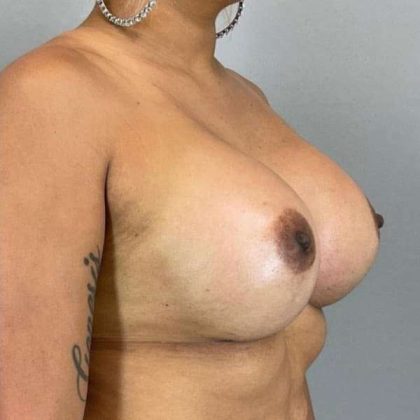 Breast Augmentation Before & After Patient #1483