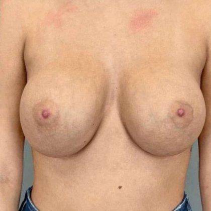 Breast Augmentation Before & After Patient #1503