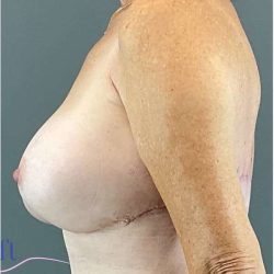 Breast Augmentation Before & After Patient #1613