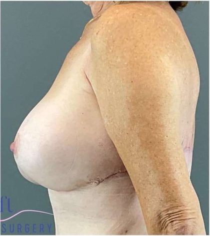 Breast Augmentation Before & After Patient #1613