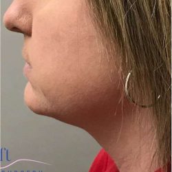 Necktite Before & After Patient #1624