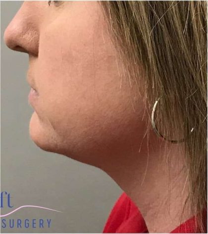 Necktite Before & After Patient #1624
