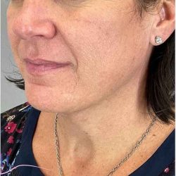 Necktite Before & After Patient #1633
