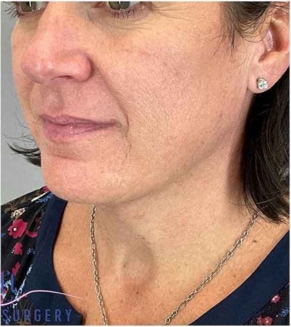 Necktite Before & After Patient #1633