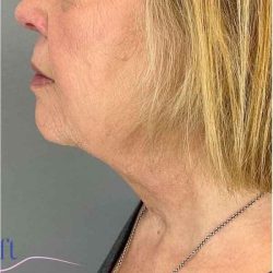 Neck Lift Before & After Patient #1649