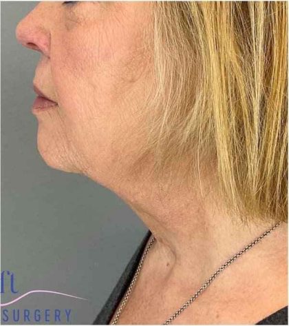 Neck Lift Before & After Patient #1649