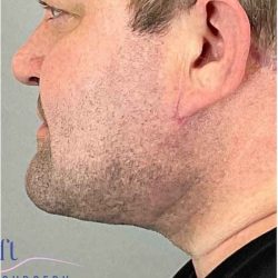 Neck Lift Before & After Patient #1660