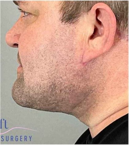 Neck Lift Before & After Patient #1660