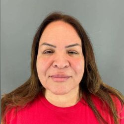 Neck Lift Before & After Patient #1678
