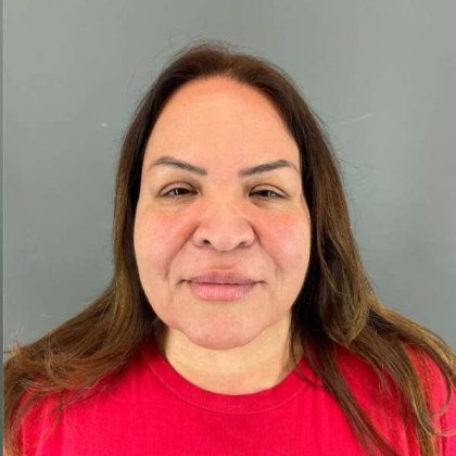 Neck Lift Before & After Patient #1678