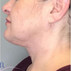 Neck Lift Before & After Patient #1696