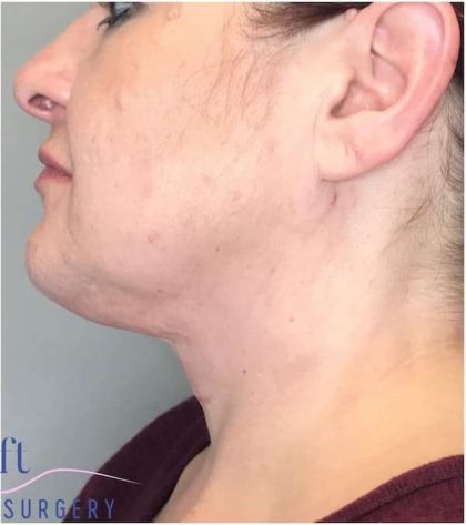 Neck Lift Before & After Patient #1696
