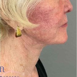 Facelift Before & After Patient #1703