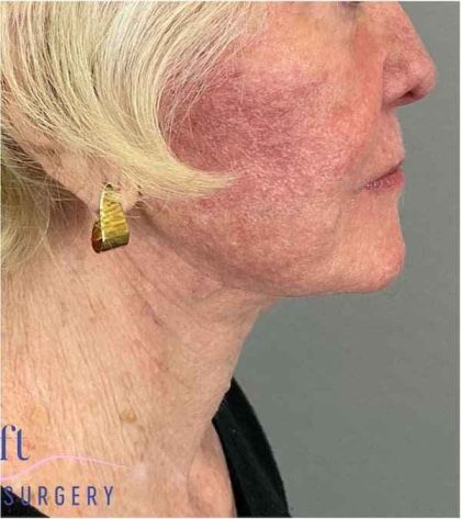 Facelift Before & After Patient #1703