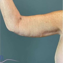 Arm Lift Before & After Patient #222