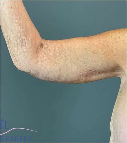 Arm Lift Before & After Patient #222
