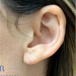 Ear Surgery Before & After Patient #1708