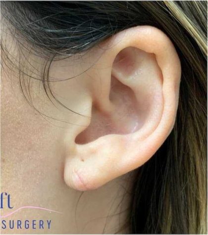 Ear Surgery Before & After Patient #1708