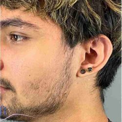 Ear Surgery Before & After Patient #1715