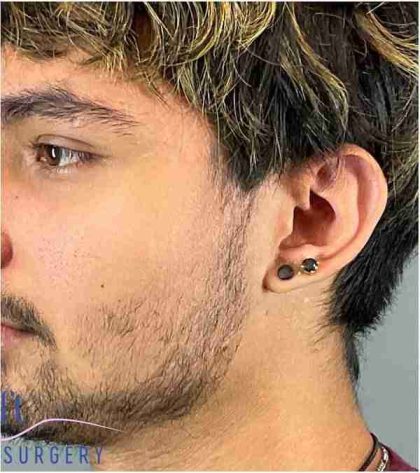 Ear Surgery Before & After Patient #1715