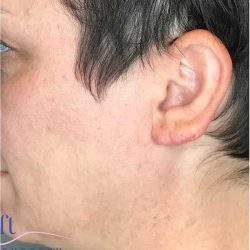 Ear Surgery Before & After Patient #1724