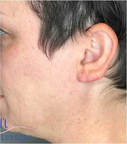 Ear Surgery Before & After Patient #1724