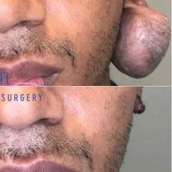 Ear Surgery Before & After Patient #1731