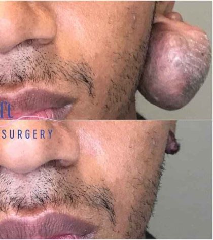 Ear Surgery Before & After Patient #1731