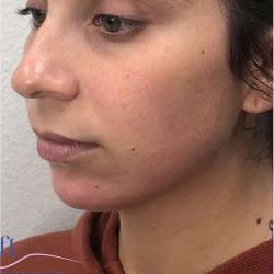 Chin Augmentation Before & After Patient #1738