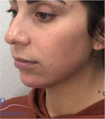 Chin Augmentation Before & After Patient #1738