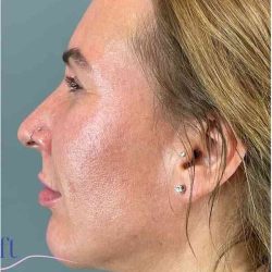 Chin Augmentation Before & After Patient #1747