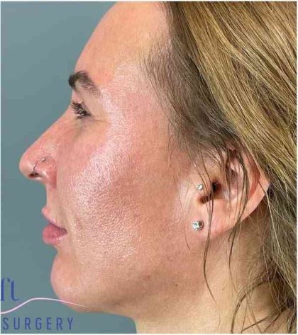Chin Augmentation Before & After Patient #1747