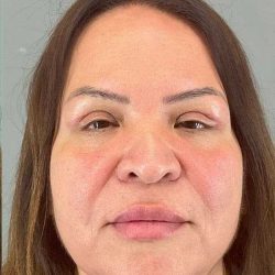 Eyelid Surgery Before & After Patient #1754
