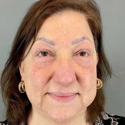 Eyelid Surgery Before & After Patient #1761