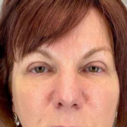 Eyelid Surgery Before & After Patient #1768