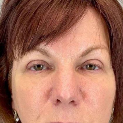 Eyelid Surgery Before & After Patient #1768