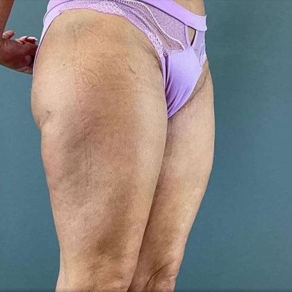 Thigh Lift Before & After Patient #233