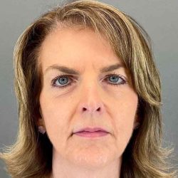 Eyelid Surgery Before & After Patient #1786