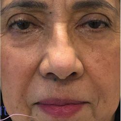 Eyelid Surgery Before & After Patient #1789