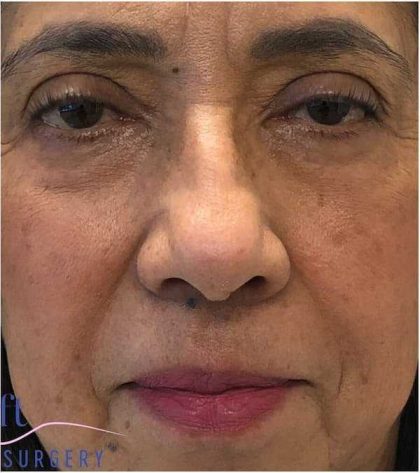 Eyelid Surgery Before & After Patient #1789