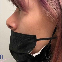 Rhinoplasty Before & After Patient #1796