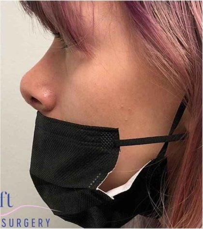 Rhinoplasty Before & After Patient #1796