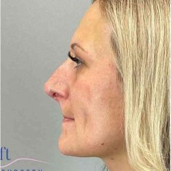 Rhinoplasty Before & After Patient #1807