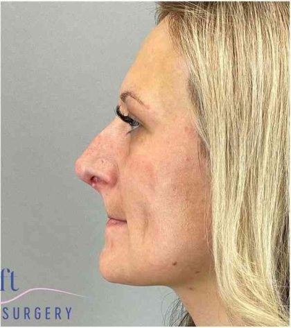 Rhinoplasty Before & After Patient #1807