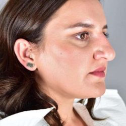Rhinoplasty Before & After Patient #1818