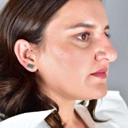 Rhinoplasty Before & After Patient #1818