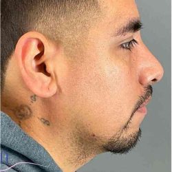 Rhinoplasty Before & After Patient #1825