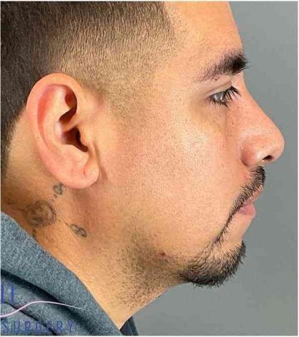 Rhinoplasty Before & After Patient #1825