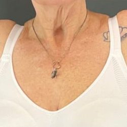 Arm Lift Before & After Patient #219