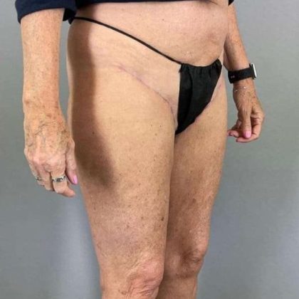 Thigh Lift Before & After Patient #240
